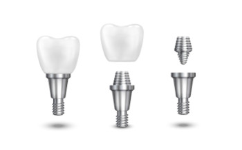 pilier intermediaire implant dentaire Marseille Saint just 