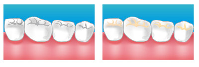 centre dentaire mareille 13013 caries dents de sagesse