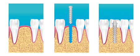 implant dentaire marseille 13013