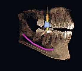 cone beam centre dentaire marseille 13